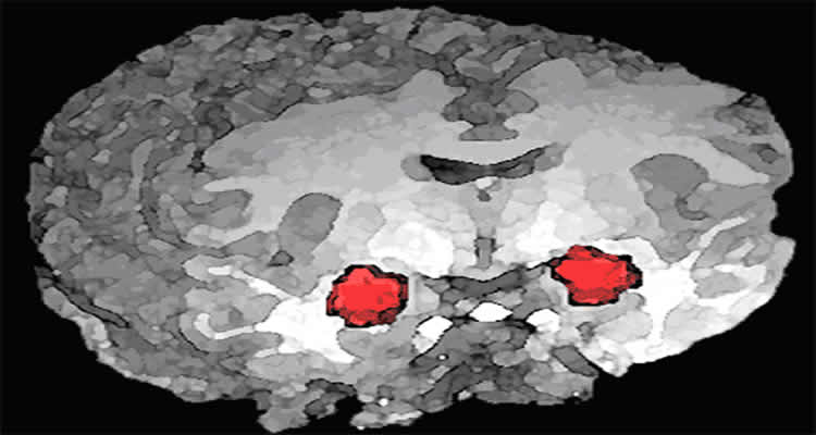 The is a brain image with the location of the amygdala highlighted.