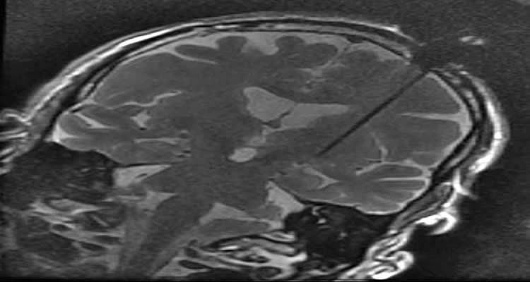 The image shows a brain scan post DBS neurosurgery.