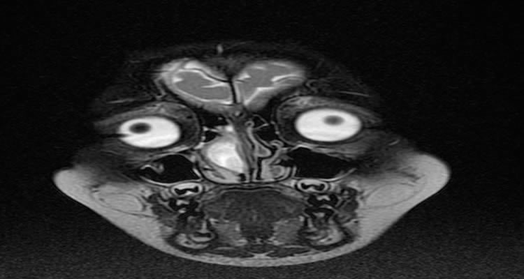 The image shows an MRI scan of a person with a nasal glioma tumor.