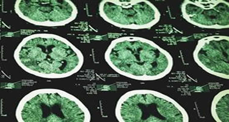 The image shows mri brain scans.