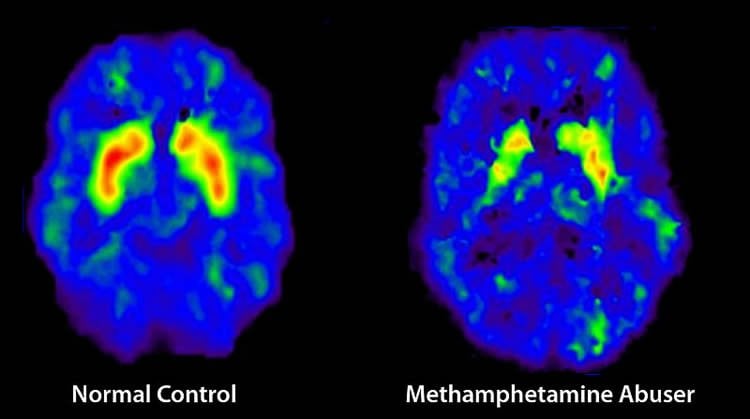 The image shows two brain scans. One is of a normal brain, the other is of a brain of a meth user.