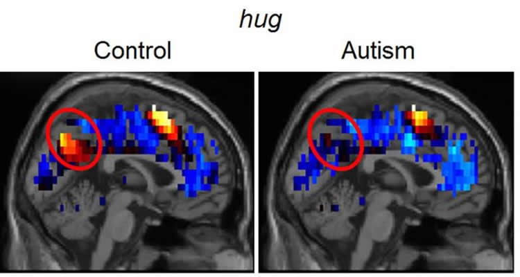 The image shows MRI brain scans of a person with autism and a control test subject. The scan reveals the neural activity when the person is hugged.