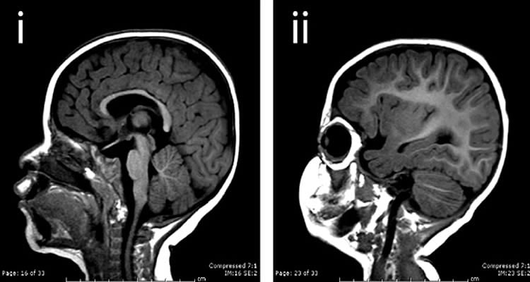 The image shows two MRI brain scans. The first is of a normal brain, the second of a person with microephaly.