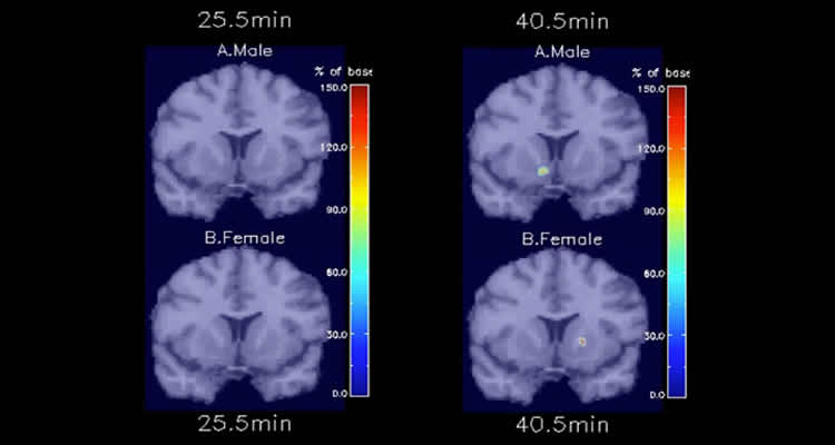 The image shows PET scans pf male and female smokers brain taken from the study.