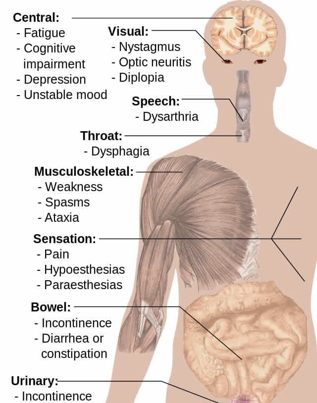 The image is a diagram showing the effects MS has on the human body.
