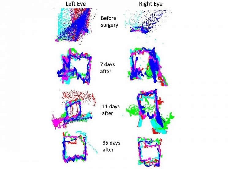 The image shows how the eye movements returned to normal after surgery.