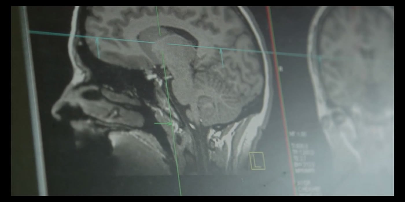 The image shows an MRI scan taken from the study.