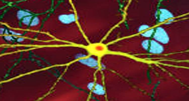 The image shows a single striatal neuron (yellow) transfected with nuclear inclusion (orange) mHtt, other neurons in background (blue).