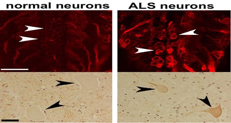 This image shows neurons from a fruit fly and a person with ALS.
