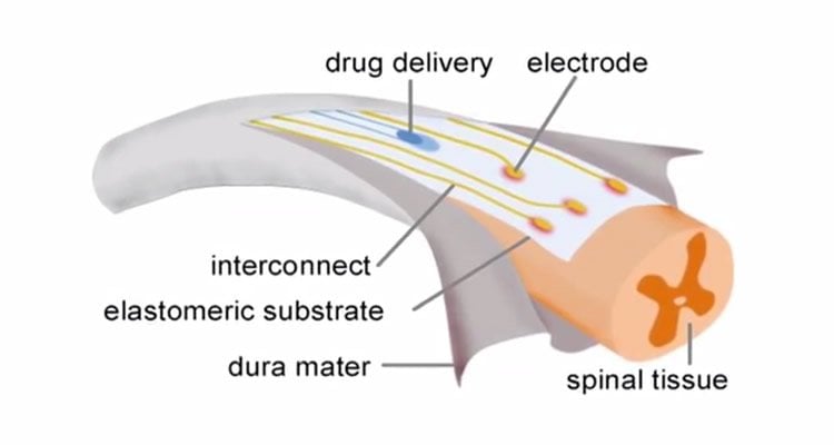 This image shows how the e-dura implant works.