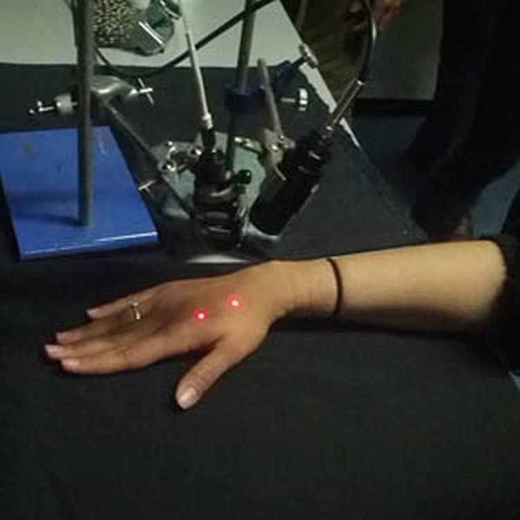 This image shows a person's hand being stimulated by a laser.