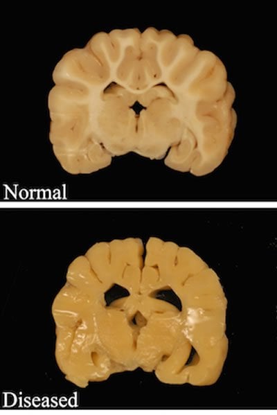 This image shows two brain slices. One has axons with normal myelin sheathing, the other is absent of myelin.