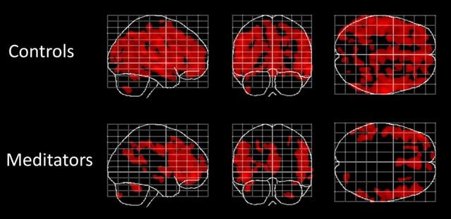 Four different images of brain scans are shown.