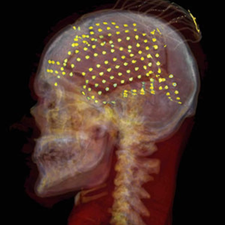 The image shows the outline of a human head with yellow dots outlining the brain.