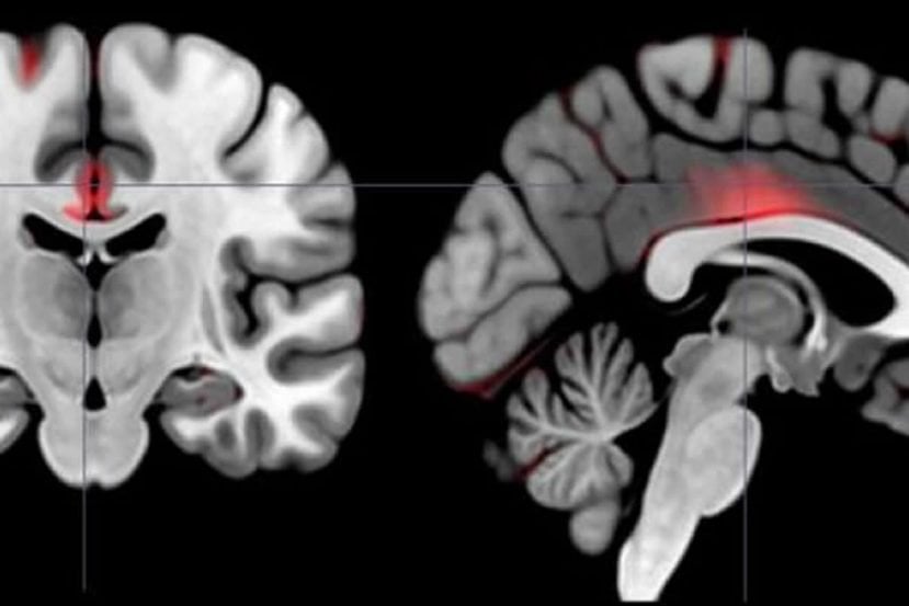 This image shows brain scans with higher levels of gray matter marked in red.