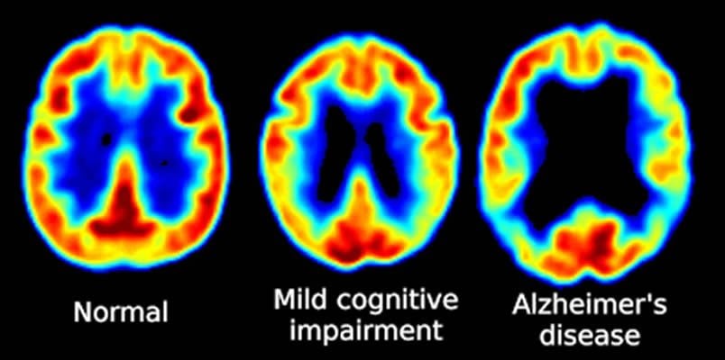 This illustration shows three PET scans of a normal brain, a brain of a person with MCI and a scan of an Alzheimer's patient.