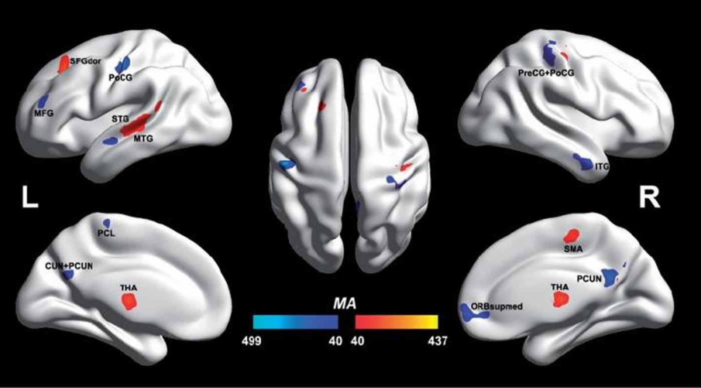 Image shows the brain scan differences between the autistic and non autistic brains.