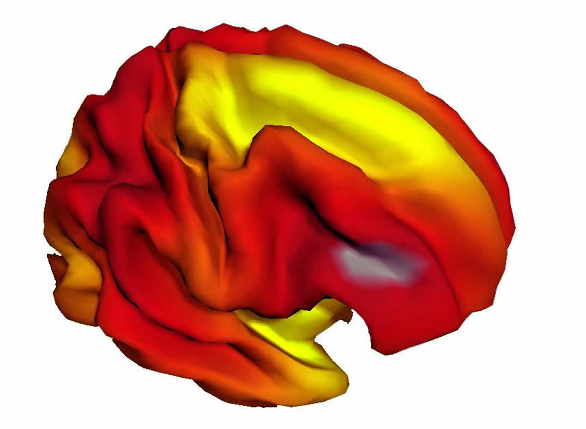 This image shows the relationship between the brain surface expansion and age in children, 3-20 years.