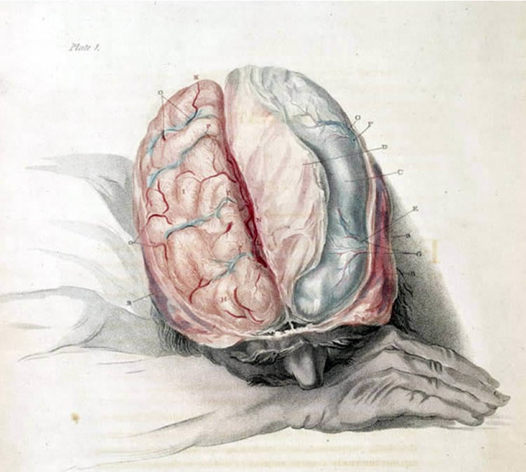 This is a drawing of a sleeping person with their brain exposed.