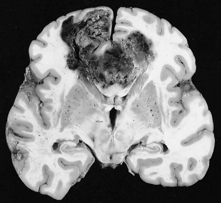 This is a brain slice with a glioblastoma brain tumor showing in it.