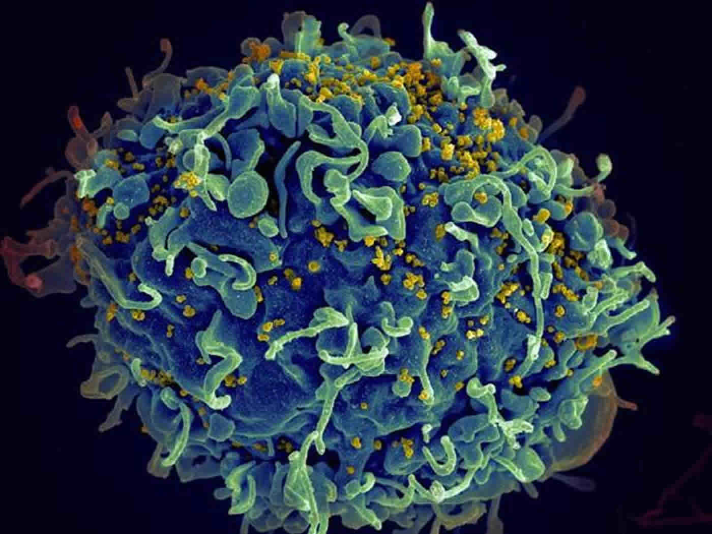 This photo shows HIV, the AIDS virus (yellow), infecting a human immune cell.
