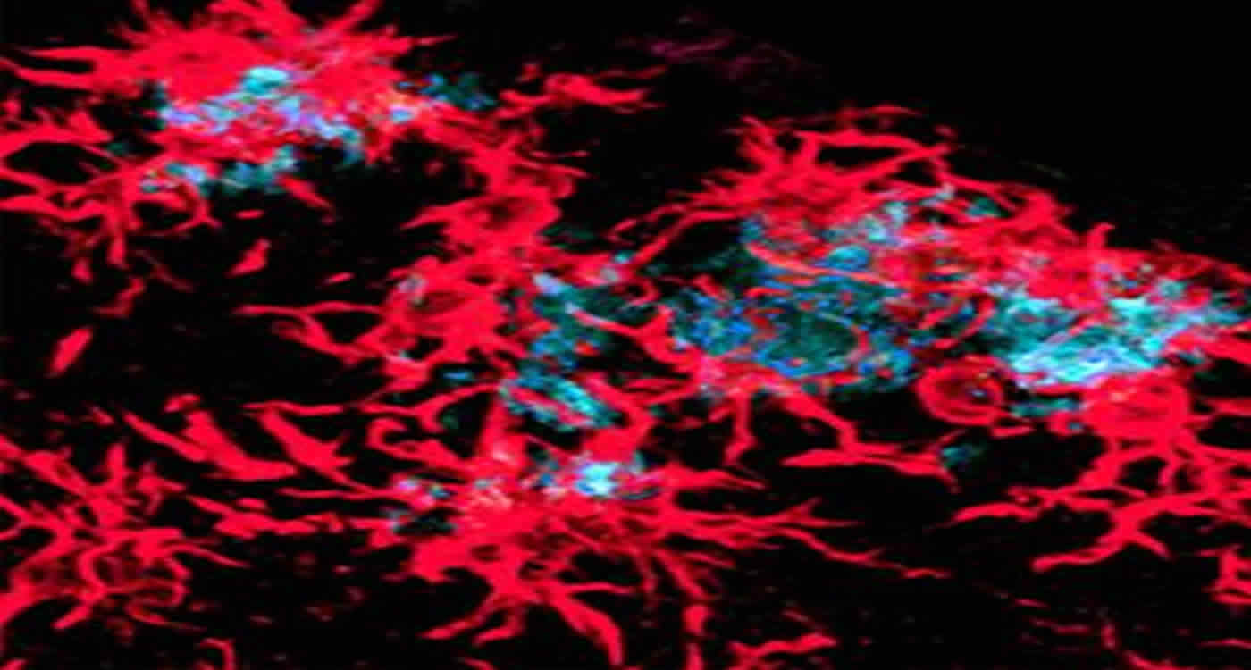 This image shows normal microglia (red) surround Alzheimer's plaques.