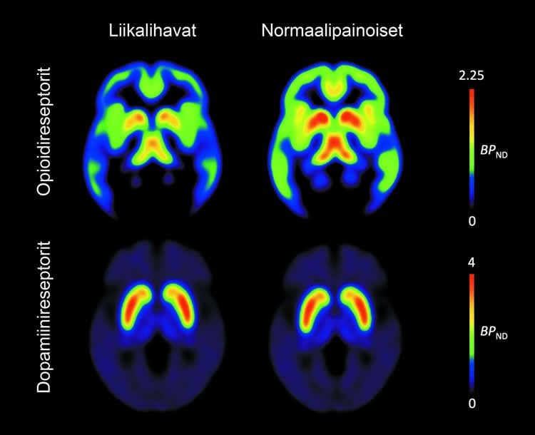This image shows four PET brain scans associated with this study.