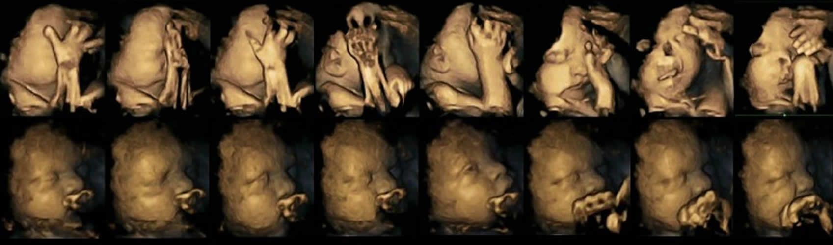 Image shows the 4D ultrasound of both babies.