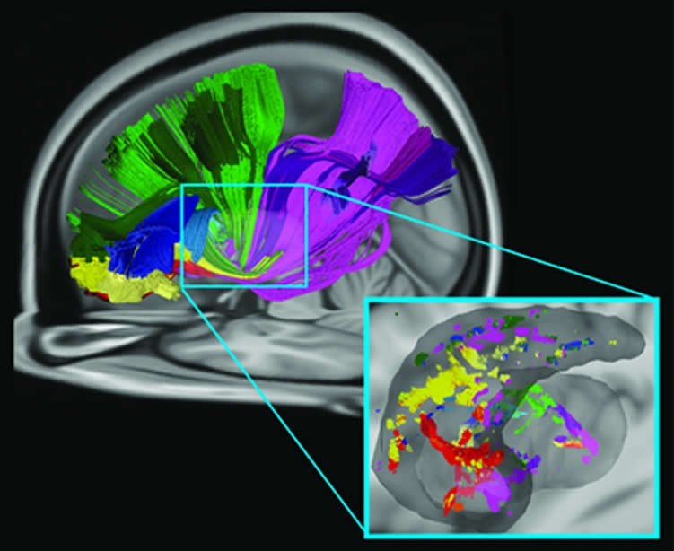 This image shows the brain scans associated with the research. The caption best describes the image.