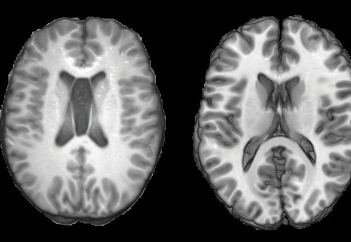 This shows mri scan of a healthy brain and one with TBI.