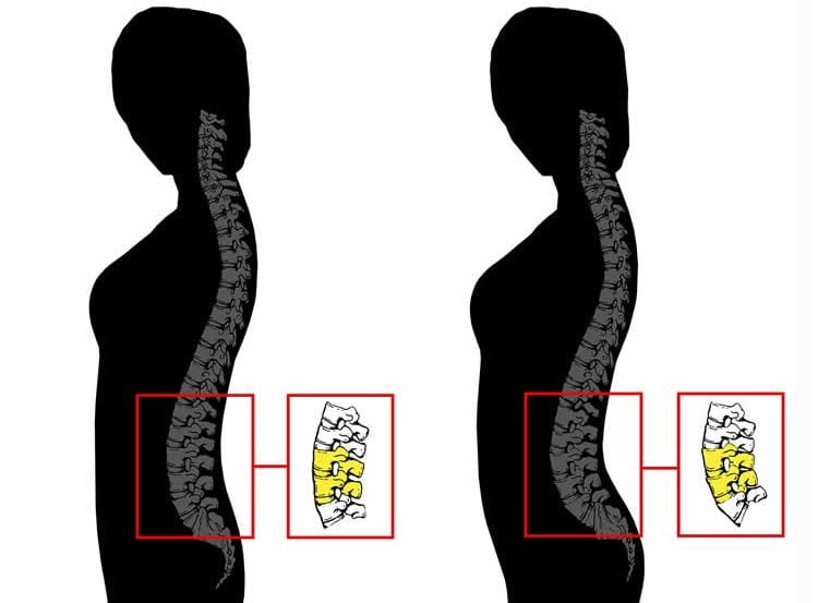Image shows the spine curvature.