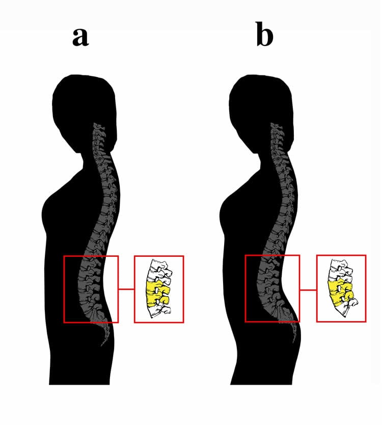 Image shows the spine curvature.