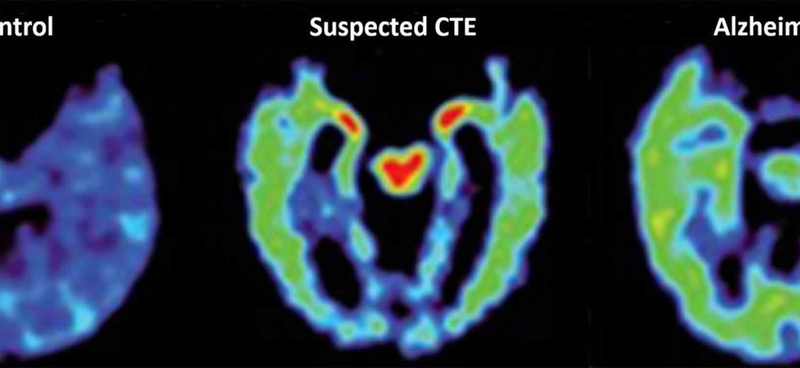 This shows normal, cte and alzheimer's brain scans.
