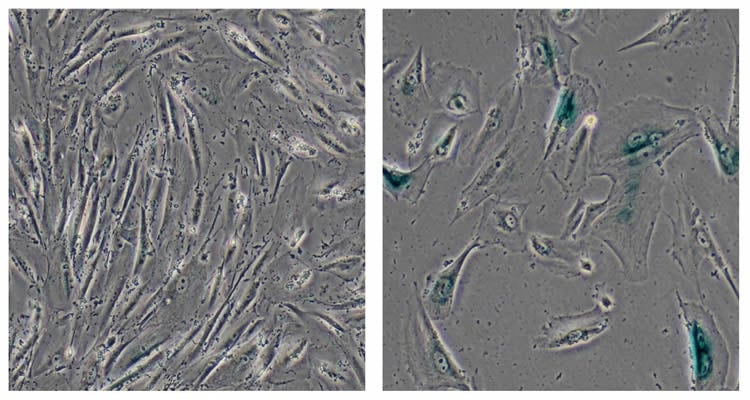 This image shows normal human cells (left) and genetically modified cells developed by the Salk scientists to model Werner syndrome (right).