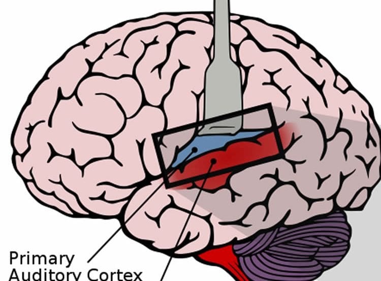This image shows a lateral view of the human brain, with the auditory cortex exposed.