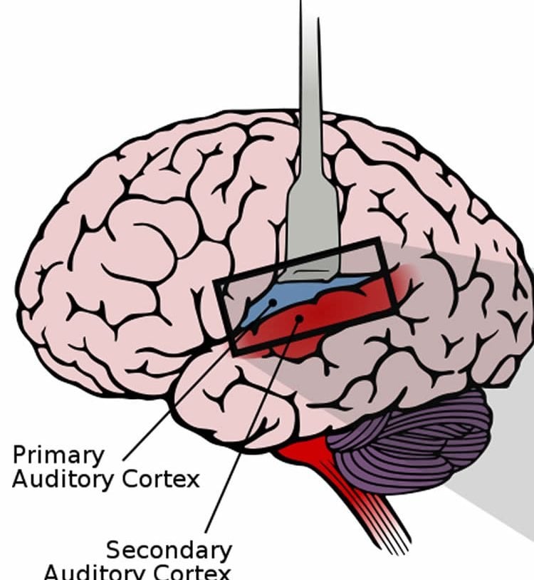 This image shows a lateral view of the human brain, with the auditory cortex exposed.