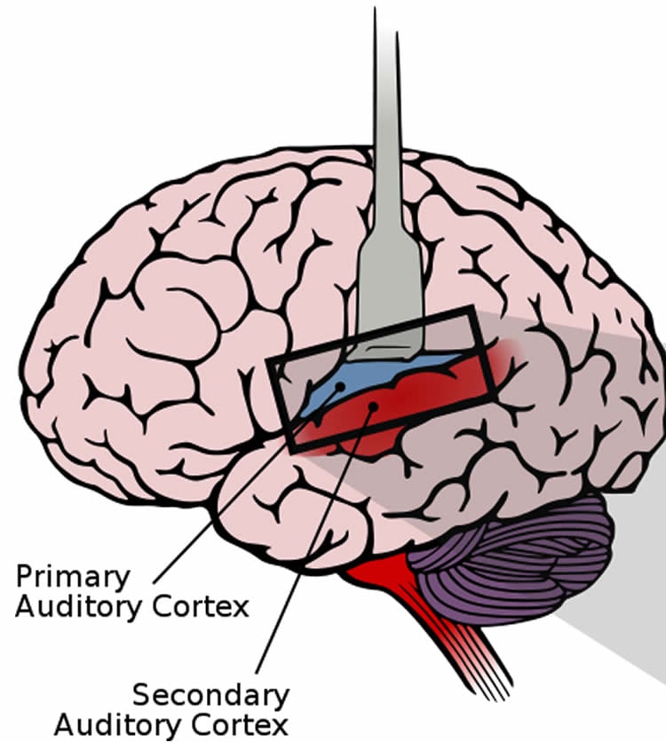 This image shows a lateral view of the human brain, with the auditory cortex exposed.