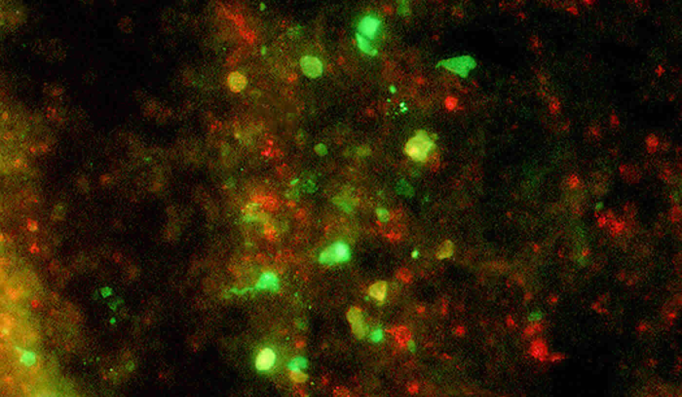 This shows the glioma tumor cells being destroyed by the chimeric virus.