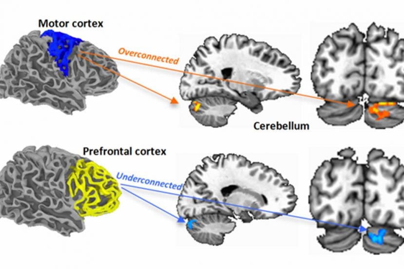 This image shows the fMRI scans which demonstrate the over and underconnectivity in the brain of children with autism.