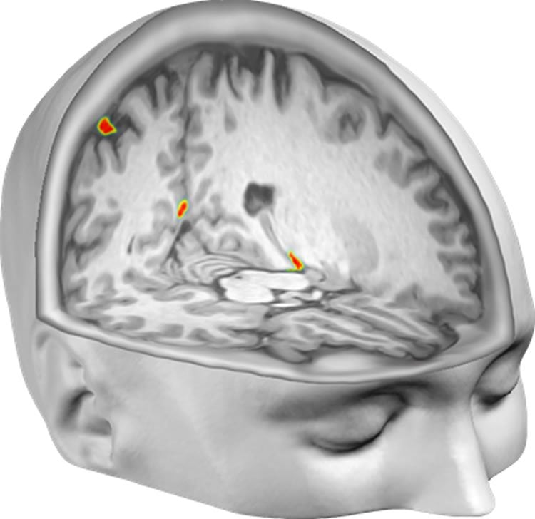 This shows a cut away head model with the brain revealed. Highlighted are the areas where the neural activity is present.