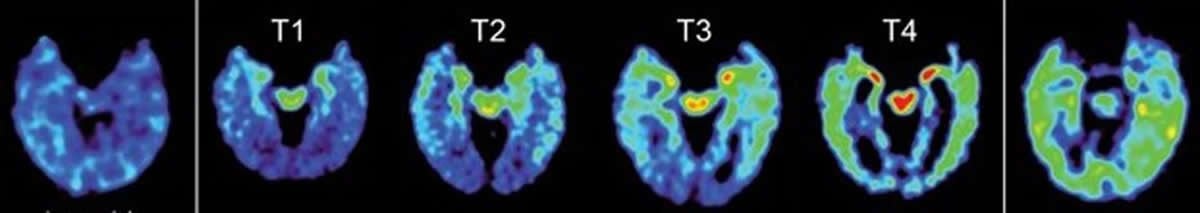 These brain scans show the 4 stages of the different abnormal protein levels seen in those with CTE.