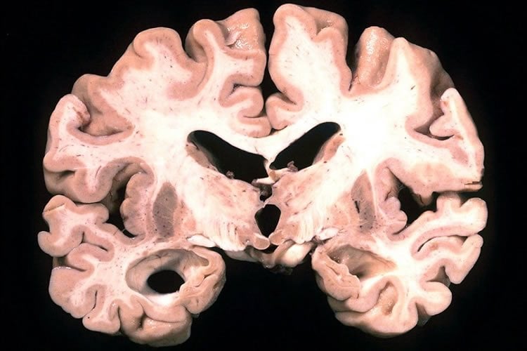 This shows a brain slice taken from a person with Alzheimer's.
