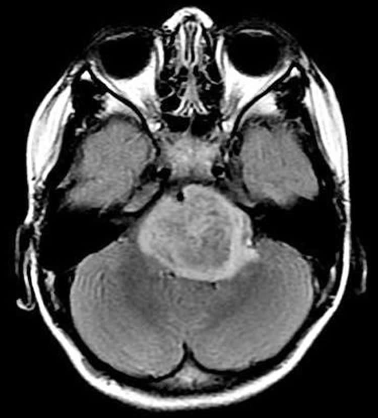 This shows a brain scan of a patient with diffuse intrinsic pontine glioma.
