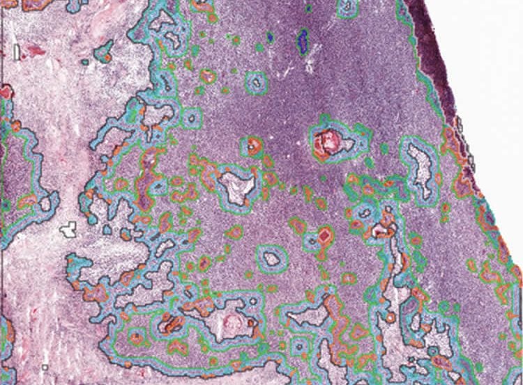 This image shows the mapped glioblastoma.