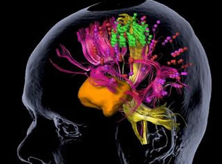 This shows the nTMS mapping of a brain tumor.