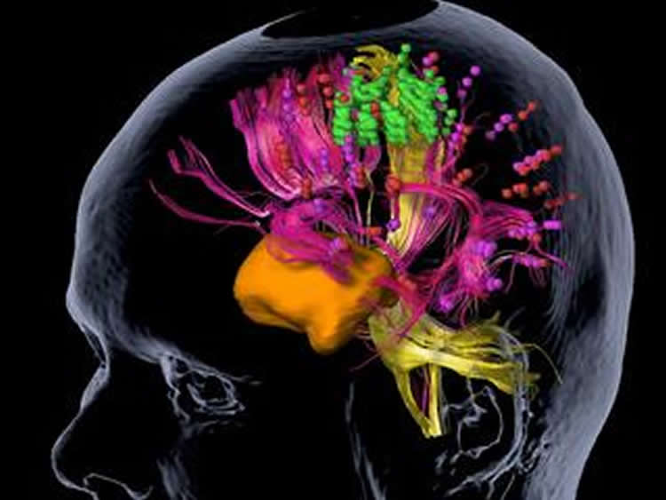 This shows the nTMS mapping of a brain tumor.