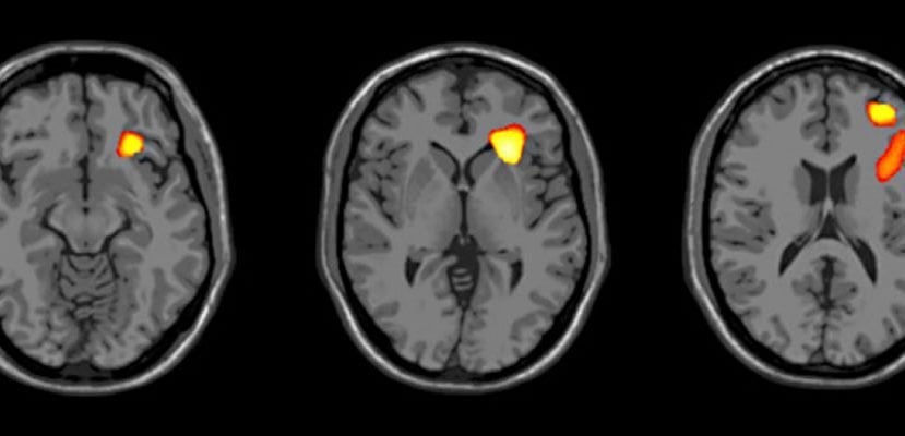This image shows brain scans with the areas with decreased volume highlighted.