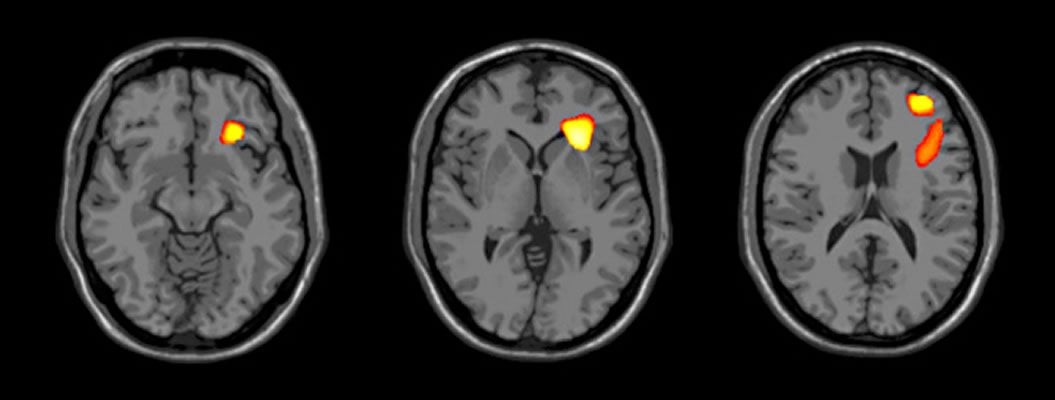 This image shows brain scans with the areas with decreased volume highlighted.