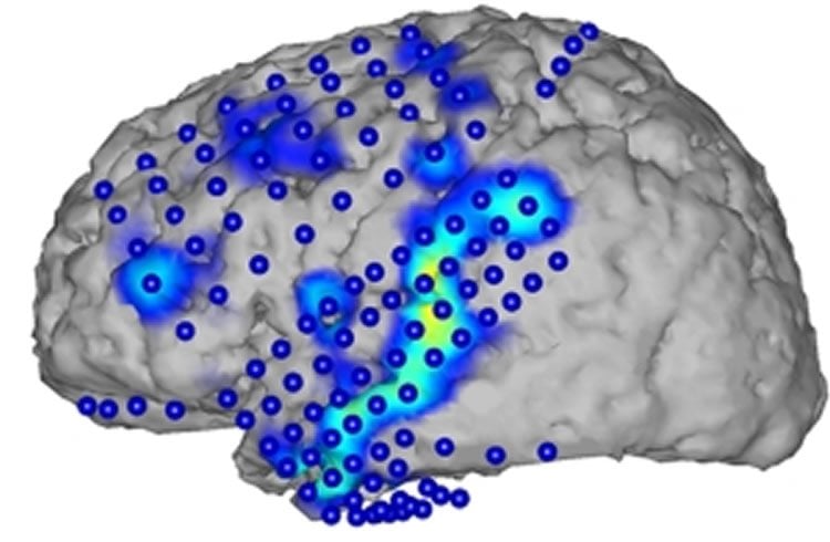 This image shows brain activity recorded by electrocorticography (blue circles). From the activity patterns (blue/yellow), spoken words can be recognized.