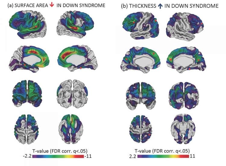 This image shows brain scans of people with Down syndrome.